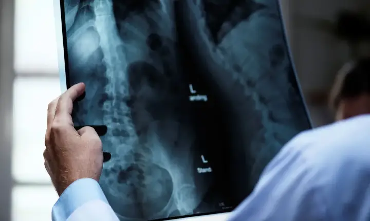 Osteoporose atinge homens e mulheres de maneira diferente; veja cuidados