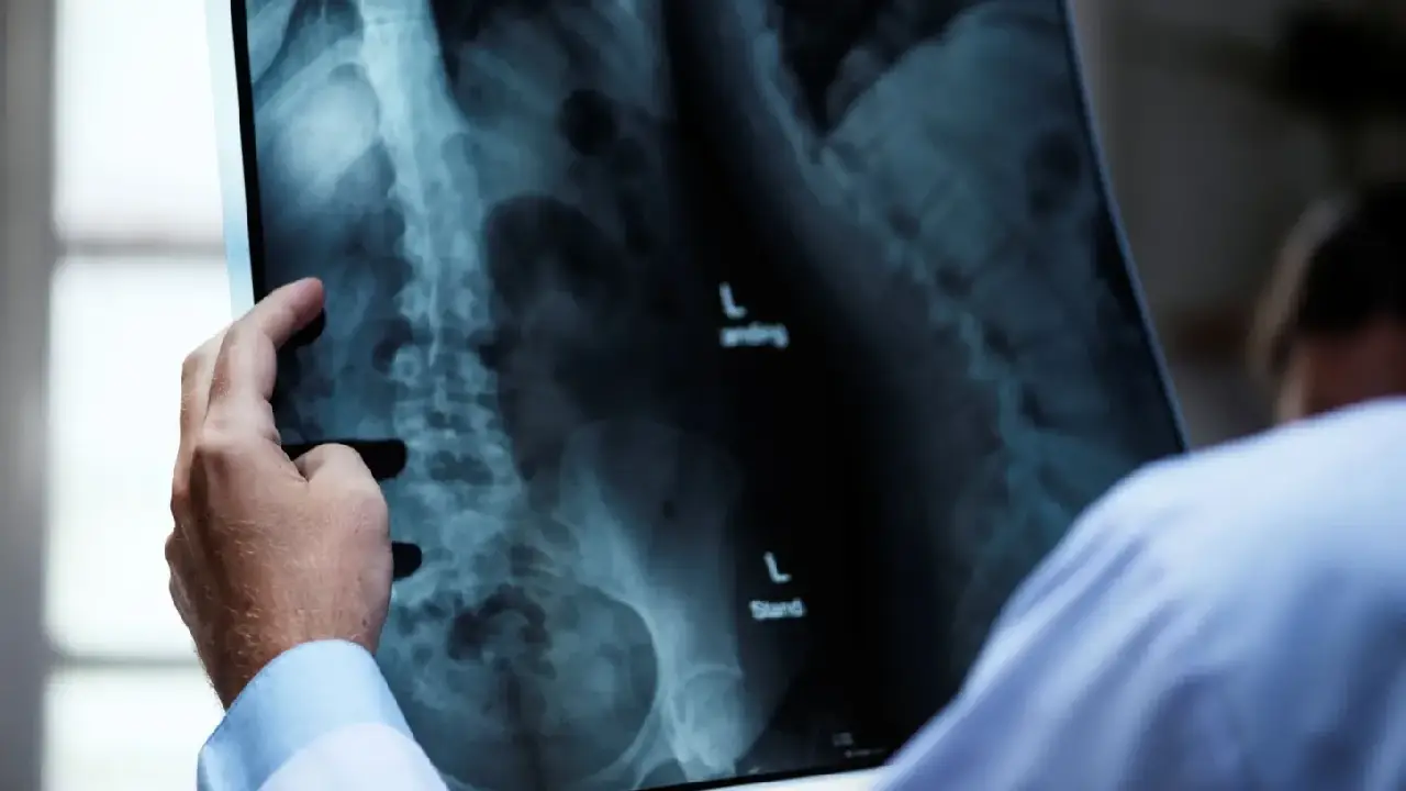 Osteoporose atinge homens e mulheres de maneira diferente; veja cuidados