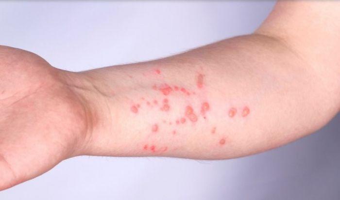 Casos de Mpox aumentam no Brasil; Veja os sintomas