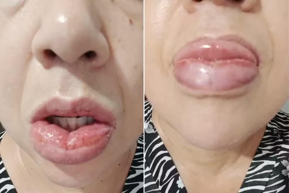 Após 1,2 mil relatos de reações, pasta da Colgate com fórmula alterada segue com venda proibida