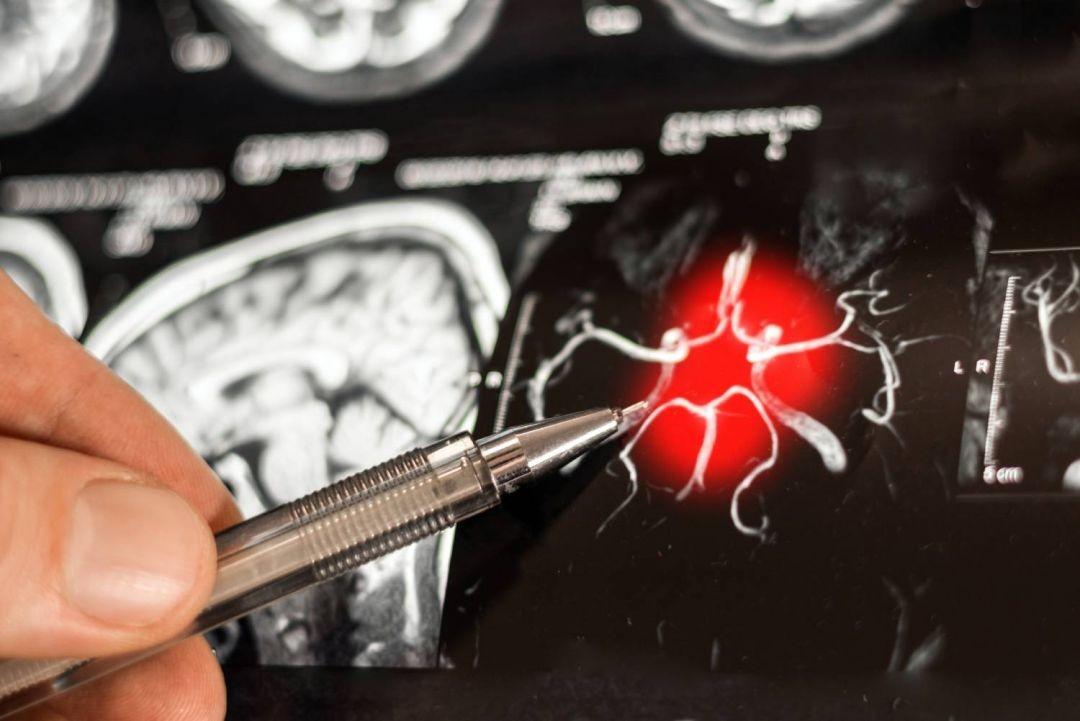 Estimativas apontam que mais de um milhão de pessoas vivem com Alzheimer no país
